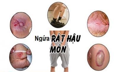 Bật mí một số dấu hiệu bệnh trĩ sau sinh Image result for Äau rát háºu môn +site://benhtri193.com