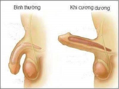 Dương vật không cương hết cỡ phải làm sao?