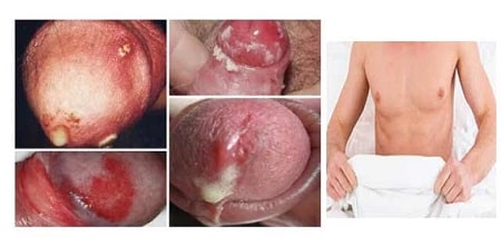 Một vài biến chứng thường gặp ở nam giới khi bị bệnh lậu ở nam giai đoạn đầu