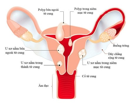 Các cách chữa u xơ tử cung được áp dụng hiện nay