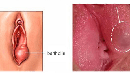 Hình ảnh viêm tuyến Bartholin là gì?