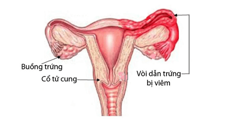 Triệu chứng của bệnh viêm ống dẫn trứng ở nữ giới