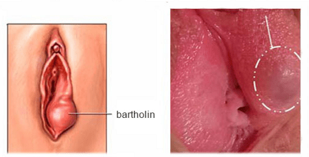 U tuyến Bartholin là bệnh gì?