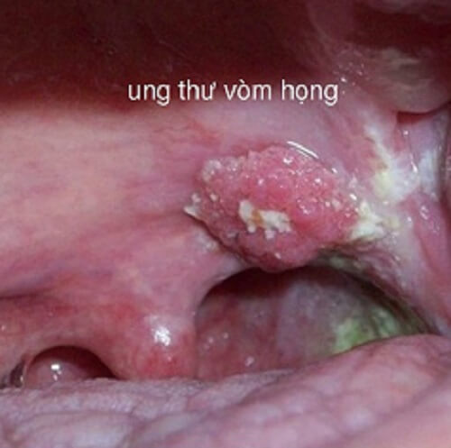 Nguy hại khôn lường của bệnh sùi mào gà ở môi: ung thư vòm họng
