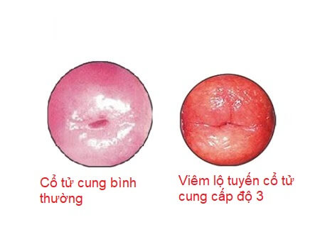 Hình ảnh viêm lộ tuyến cổ tử cung độ 3
