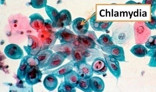 Hình ảnh bệnh Chlamydia