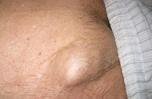 Nổi Cục Mụn Ở Vùng Kín