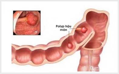 Điều trị bệnh polyp hậu môn như thế nào?