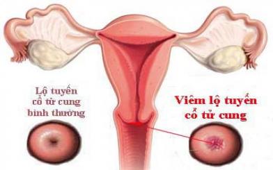 Viêm lộ tuyến cổ tử cung gây rối loạn tình dục ở nữ giới