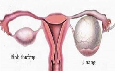 U nang tử cung: nguyên nhân, triệu chứng và phương pháp điều trị 