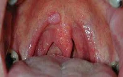 Sùi mào gà ở cổ họng : Nguyên nhân, triệu chứng và cách điều trị