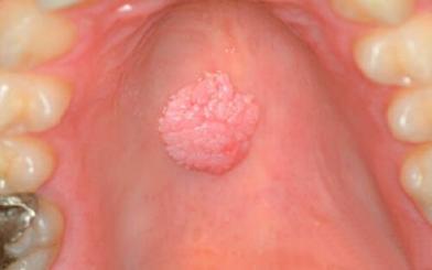 Bệnh sùi mào gà ở miệng : Nguyên nhân, triệu chứng và cách điều trị hiệu quả