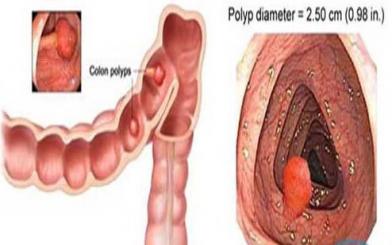 Trĩ nội có polyp có nguy hiểm không?