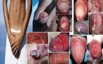 Viêm nhiễm dương vật – Nguyên nhân, triệu chứng và cách điều trị