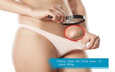 Nổi hạch ở bộ phận sinh dục nữ - Hiểm họa chớ coi thường!