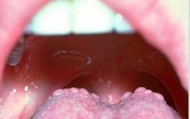 Dưới lưỡi nổi hột điều trị ở nhà hiệu quả không?