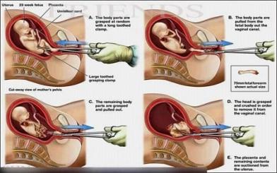 [ Review ] Quy trình nạo phá thai đúng theo chuẩn y tế mới nhất 2022