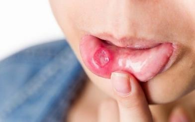 Bệnh giang mai ở miệng : Nguyên nhân, triệu chứng và cách điều trị hiệu quả
