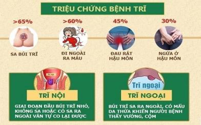 5+ cách chữa bệnh trĩ ngoại an toàn mà hiệu quả 