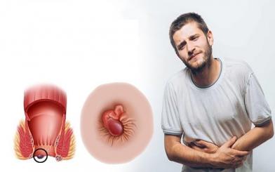 Những dấu hiệu trĩ nội dễ nhận biết hiện nay