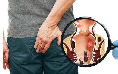 Áp Xe Hậu Môn bao lâu khỏi? Thời gian hồi phục và lưu ý quan trọng