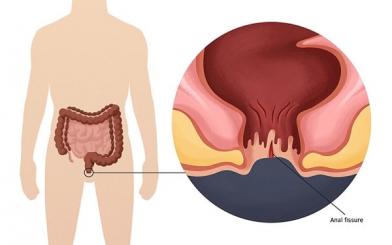 Rò lỗ hậu môn: Nguyên nhân, dấu hiệu và cách điều trị hiệu quả nhất