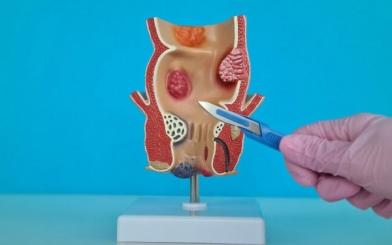 Bệnh rò hậu môn có tái phát không? Nguyên nhân & cách phòng ngừa hiệu quả