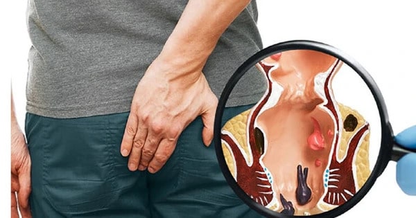 Hiểu đúng vai trò của thuốc trong điều trị áp xe hậu môn