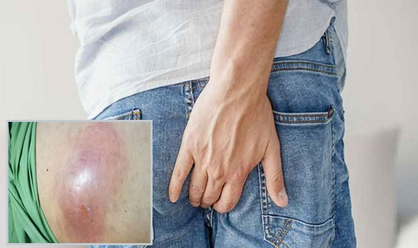 Áp xe hậu môn là bệnh gì, có nguy hiểm không?