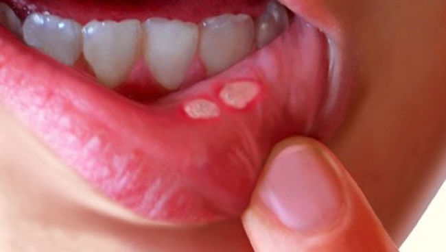 Nổi hột đỏ ở cuống lưỡi- Biểu hiện của bệnh nhiệt miệng