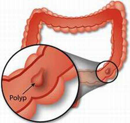 Biểu hiện polyp hậu môn