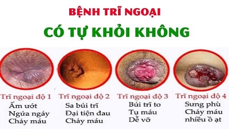 [Giải đáp] Bệnh trĩ ngoại có tự hết được không ?