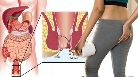 Bệnh trĩ ngoại nên kiêng làm gì ?