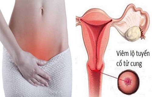 Ra khí hư lẫn máu khiến nữ giới mắc bệnh viêm lộ tuyến cổ tử cung
