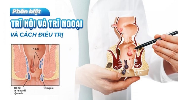 Phân biệt biểu hiện của trĩ nội và trĩ ngoại