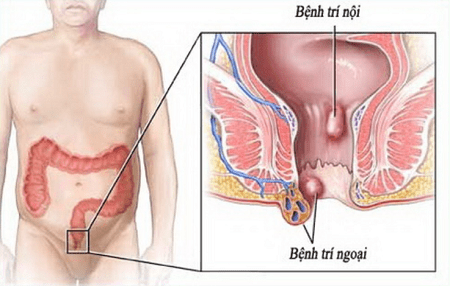 Cách phát hiện trĩ ngoại thông qua quan sát vị trí búi trĩ