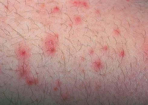 Bệnh nấm nam khoa- các bệnh về nấm: xuất hiện nốt mẩn đỏ