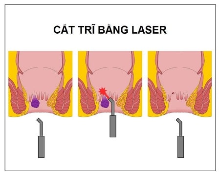 Cắt trĩ bằng Laser