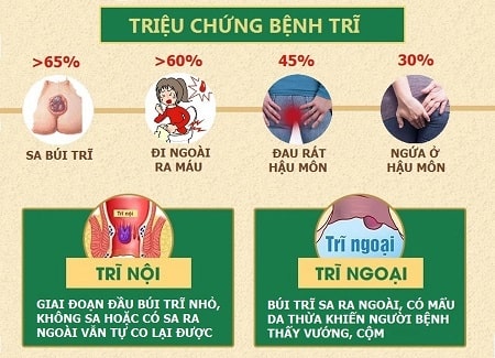 Nhận biết nhanh dấu hiệu bệnh trĩ ngoại nhẹ