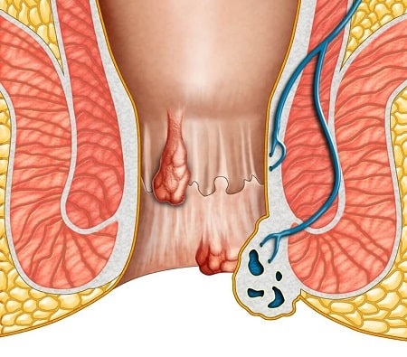 Tuyệt đối đừng trì hoãn điều trị bệnh trĩ ngoại