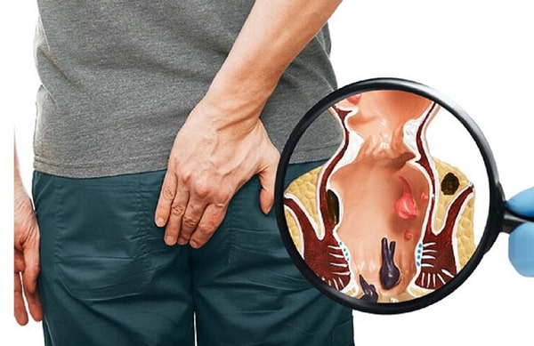 Các cách trị áp xe hậu môn đang được áp dụng hiện nay