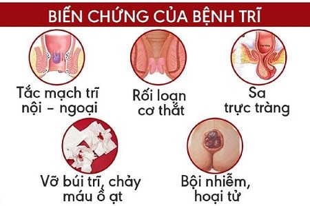 Mức độ nguy hiểm của từng cấp độ trĩ ngoại 