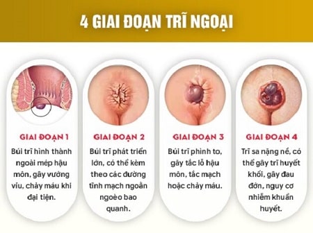 Các cấp độ trĩ ngoại và dấu hiệu nhận biết