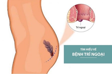 Tìm hiểu chung về trĩ ngoại