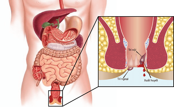 Vì sao không được chủ quan với bệnh trĩ nội?