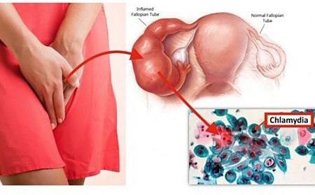 Khái niệm về bệnh chlamydia đường sinh dục