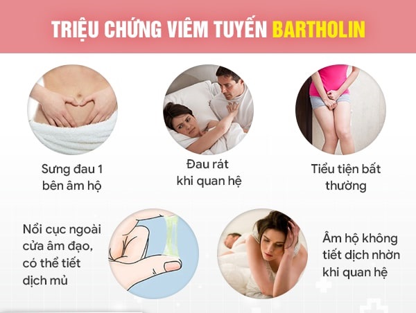 Triệu chứng của viêm tuyến bartholin mãn tính như thế nào?