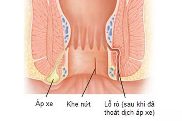 Thế nào là áp xe hậu môn? Vì đâu bệnh hình thành