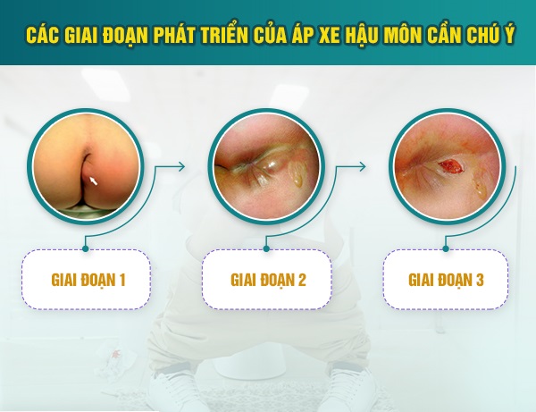 Nhận diện nhanh 4 dấu hiệu áp xe hậu môn điển hình