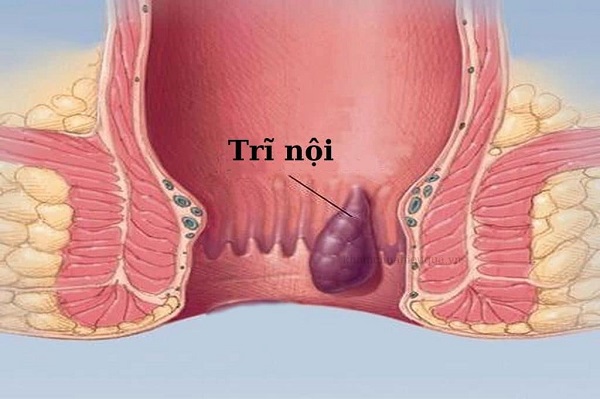 Bệnh trĩ nội nên hiểu sao cho đúng?